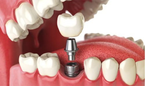 Implantes