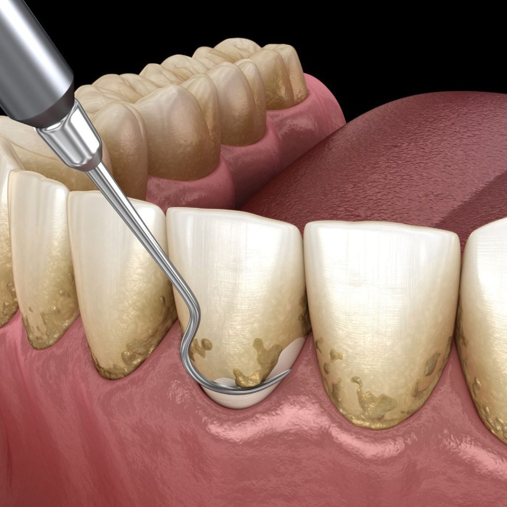 Periodoncia
