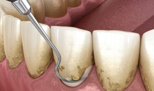 Foto de periodoncia